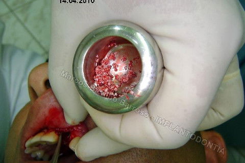 Implante Unitário - Resolução para Situações de Fraturas Radiculares com Ocorrência de Inflamação / Infecção