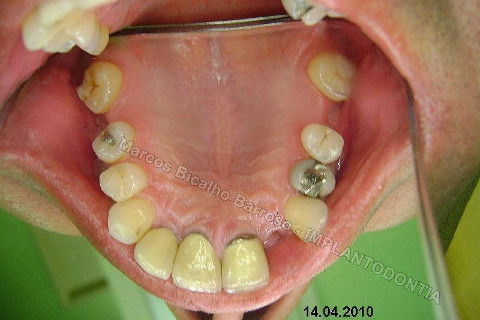 Implante Unitário - Resolução para Situações de Fraturas Radiculares com Ocorrência de Inflamação / Infecção