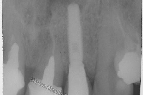 Implante Unitário - Resolução para Situações de Fraturas Radiculares com Ocorrência de Inflamação / Infecção