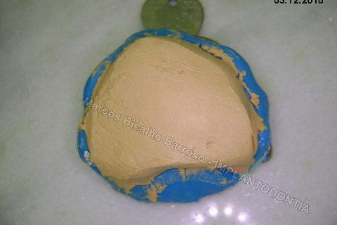 Implante Unitário - Resolução para Situações de Fraturas Radiculares com Ocorrência de Inflamação / Infecção