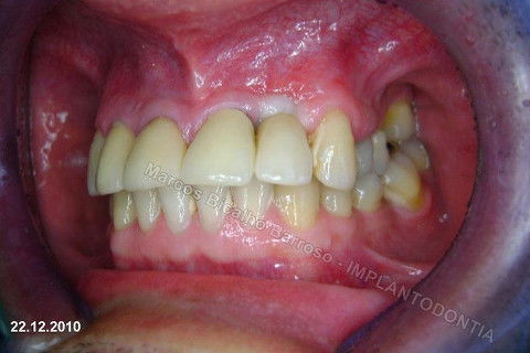 Depois de concluído o trabalho indicamos o paciente para o retorno ao colega que me indicou o trabalho de implantodontia, para continuação de tratamentos de dentística e orientações para higiene oral.