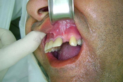 Início da cirurgia para fixação do implante, 3 meses depois.