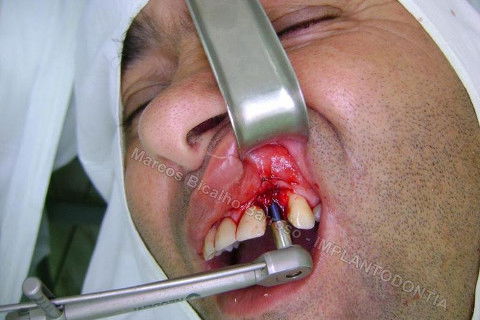 Implante Unitário - Resolução para Situações de Fraturas Radiculares com Ocorrência de Inflamação / Infecção