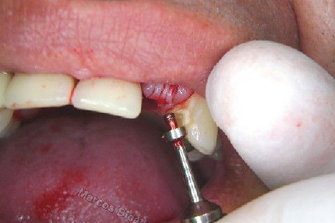 Implante Unitário - Resolução para Situações de Fraturas Radiculares com Ocorrência de Inflamação / Infecção