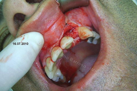 Implante Unitário - Resolução para Situações de Fraturas Radiculares com Ocorrência de Inflamação / Infecção