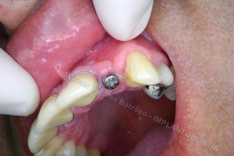 Reparem no aumento do volume da gengiva inserida na face vestibular. Isto vai ser bom para a estética periimplantar. Esta situação é recente, ainda ocorrerá remodelação após instalação da coroa sobre o implante. O melhor seria um provisório antes da coroa definitiva, mas o paciente está muito ansioso para esperar, reclamando da demora, então instalarei a coroa definitiva de uma vez. Mas creio que ficará bom.