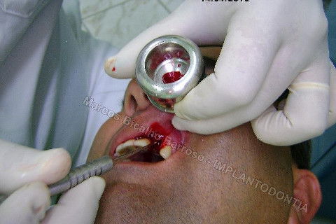 Colhendo um pouco de sangue para misturar ao biomaterial