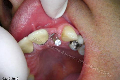 Implante Unitário - Resolução para Situações de Fraturas Radiculares com Ocorrência de Inflamação / Infecção