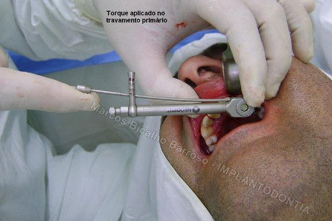 Implante Unitário - Resolução para Situações de Fraturas Radiculares com Ocorrência de Inflamação / Infecção