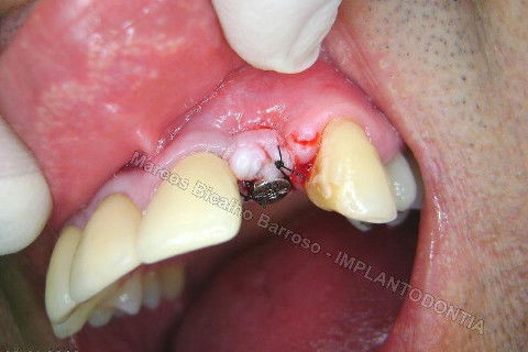 Implante Unitário - Resolução para Situações de Fraturas Radiculares com Ocorrência de Inflamação / Infecção