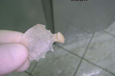 Implante Unitário - Resolução para Situações de Fraturas Radiculares com Ocorrência de Inflamação / Infecção