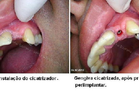 Implante Unitário - Resolução para Situações de Fraturas Radiculares com Ocorrência de Inflamação / Infecção