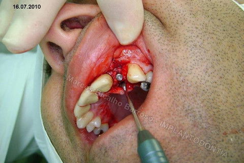 Implante Unitário - Resolução para Situações de Fraturas Radiculares com Ocorrência de Inflamação / Infecção