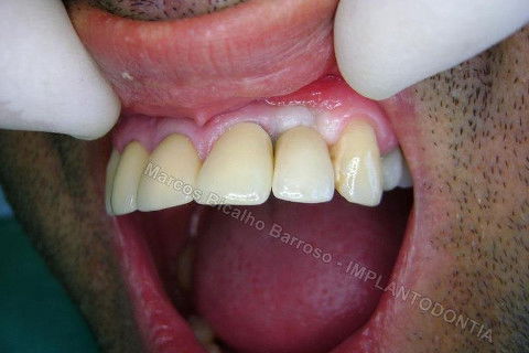 Implante Unitário - Resolução para Situações de Fraturas Radiculares com Ocorrência de Inflamação / Infecção