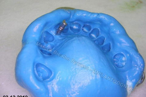 Conjunto transfer + análogo do implante adaptados na moldagem