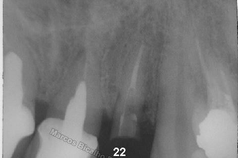 Implante Unitário - Resolução para Situações de Fraturas Radiculares com Ocorrência de Inflamação / Infecção
