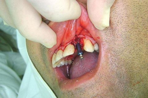 Implante Unitário - Resolução para Situações de Fraturas Radiculares com Ocorrência de Inflamação / Infecção