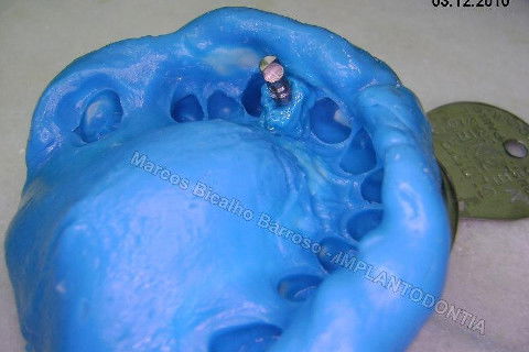 Vazamento da gengiva artificial