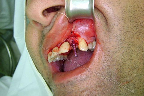 Implante Unitário - Resolução para Situações de Fraturas Radiculares com Ocorrência de Inflamação / Infecção