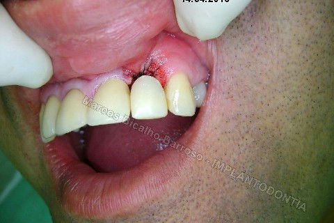 Implante Unitário - Resolução para Situações de Fraturas Radiculares com Ocorrência de Inflamação / Infecção