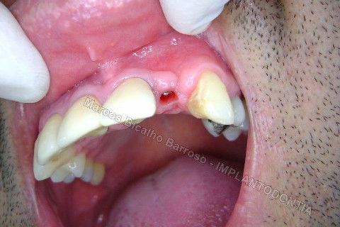 Implante Unitário - Resolução para Situações de Fraturas Radiculares com Ocorrência de Inflamação / Infecção