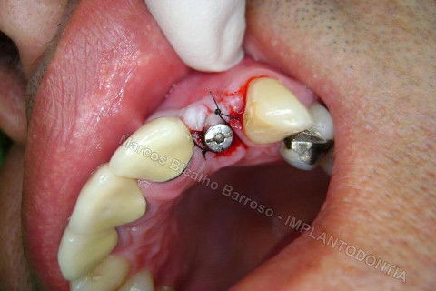 Implante Unitário - Resolução para Situações de Fraturas Radiculares com Ocorrência de Inflamação / Infecção