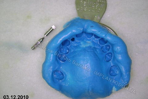 Moldagem, transfer e análogo do implante