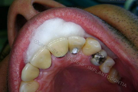 Implante Unitário - Resolução para Situações de Fraturas Radiculares com Ocorrência de Inflamação / Infecção