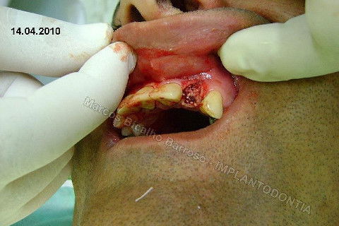 Implante Unitário - Resolução para Situações de Fraturas Radiculares com Ocorrência de Inflamação / Infecção