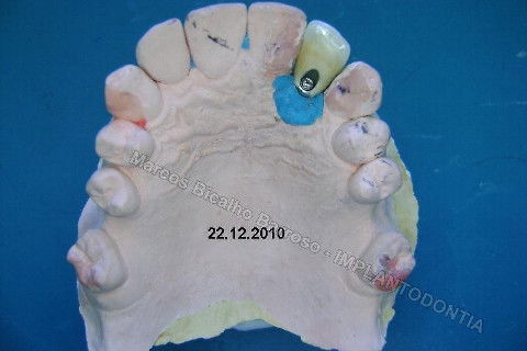 Implante Unitário - Resolução para Situações de Fraturas Radiculares com Ocorrência de Inflamação / Infecção