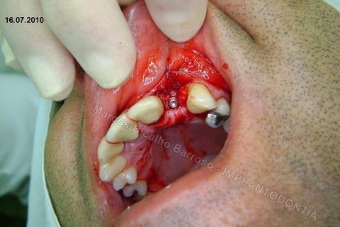 Implante Unitário - Resolução para Situações de Fraturas Radiculares com Ocorrência de Inflamação / Infecção