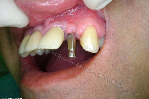 Implante Unitário - Resolução para Situações de Fraturas Radiculares com Ocorrência de Inflamação / Infecção