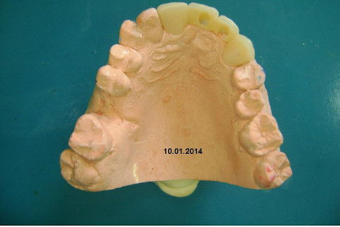 Reabilitação com Implantes em Situações de Colapso Oclusal