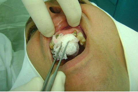 Reabilitação com Implantes em Situações de Colapso Oclusal