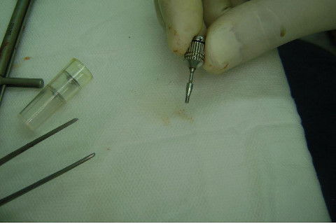 Reabilitação com Implantes em Situações de Colapso Oclusal