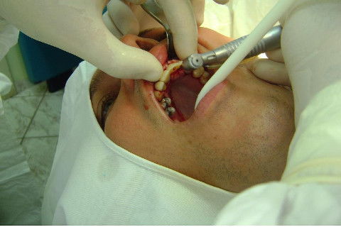 Reabilitação com Implantes em Situações de Colapso Oclusal