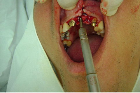 Reabilitação com Implantes em Situações de Colapso Oclusal