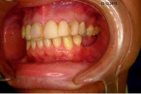 Reabilitação com Implantes em Situações de Colapso Oclusal