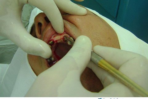 Reabilitação com Implantes em Situações de Colapso Oclusal