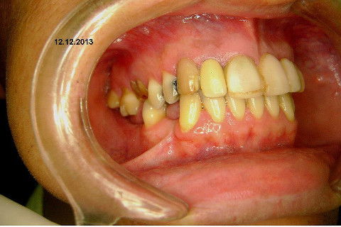 Reabilitação com Implantes em Situações de Colapso Oclusal