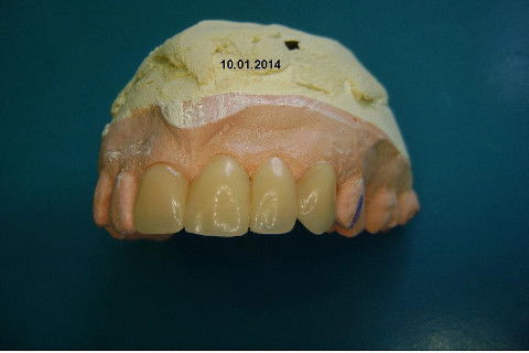 Reabilitação com Implantes em Situações de Colapso Oclusal