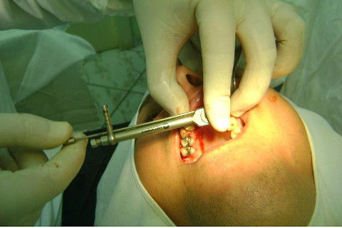 Reabilitação com Implantes em Situações de Colapso Oclusal