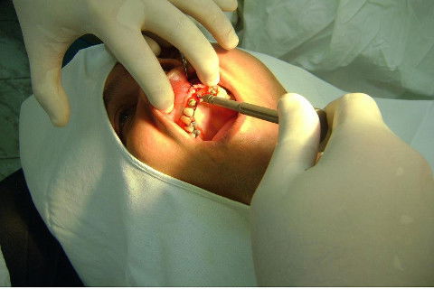 Reabilitação com Implantes em Situações de Colapso Oclusal