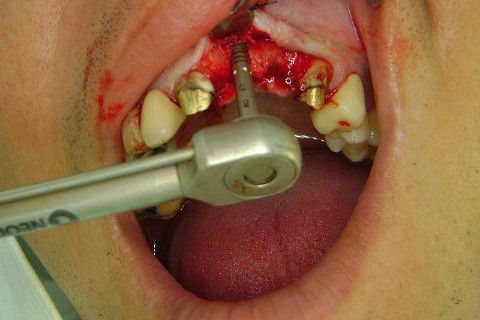 Reabilitação com Implantes em Situações de Colapso Oclusal