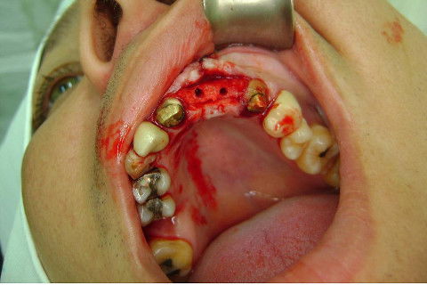 Reabilitação com Implantes em Situações de Colapso Oclusal