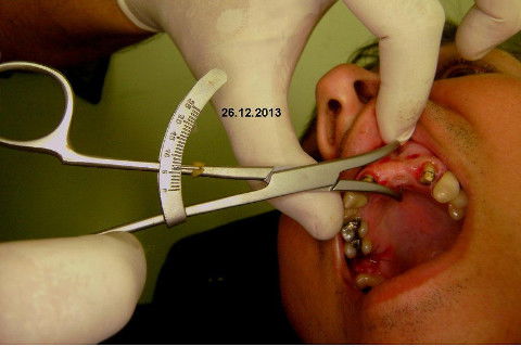 Reabilitação com Implantes em Situações de Colapso Oclusal