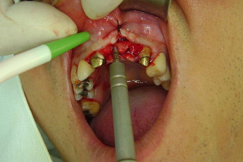 Reabilitação com Implantes em Situações de Colapso Oclusal