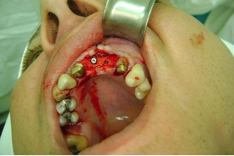 Reabilitação com Implantes em Situações de Colapso Oclusal