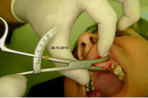 Reabilitação com Implantes em Situações de Colapso Oclusal