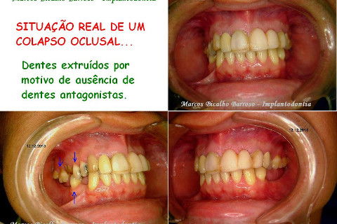 Reabilitação com Implantes em Situações de Colapso Oclusal